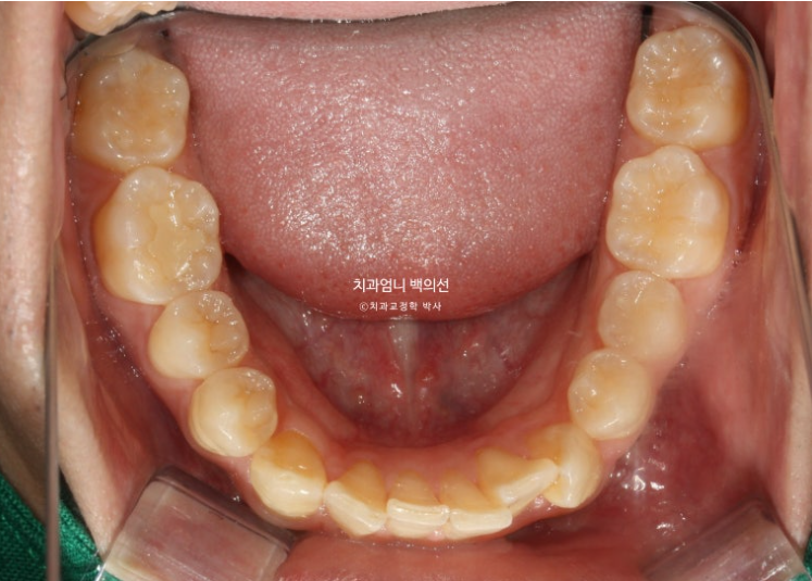 인비절라인 비발치 앞니 돌출 교정 치료기간 2년 5개월 관련 이미지 5