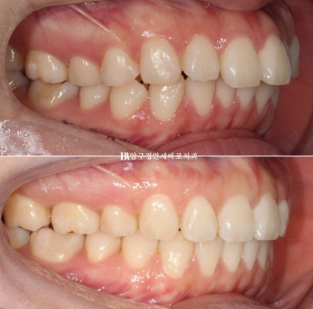 Gummy Smile Correction Review | Natural Improvement of Gummy Smile and Buccal Corridors Through Extraction Treatment for Protruding Teeth image 12
