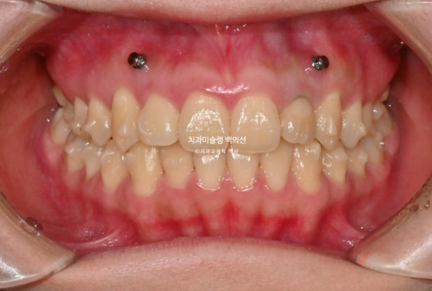 잇몸미소 인비절라인 거미스마일 토끼이빨 교정 무삭제 라미네이트 반대교합 치료 후기 관련 이미지 8