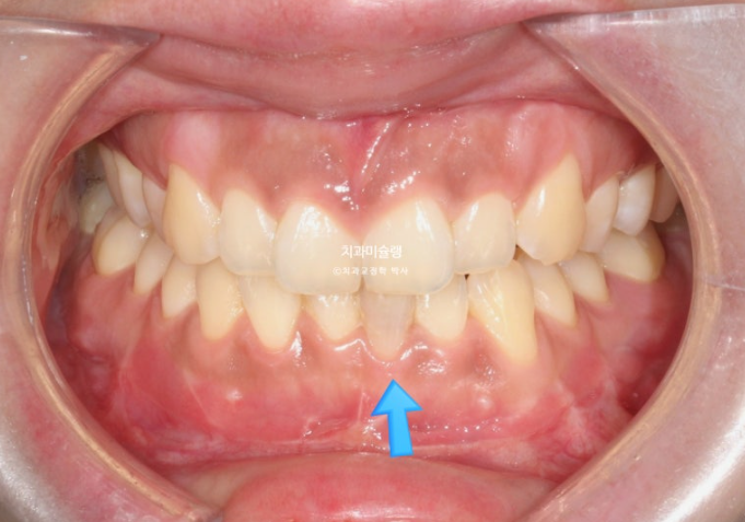 선수술 양악수술 비대칭 주걱턱 잇몸미소 치료 인비절라인 라이트 관련 이미지 3