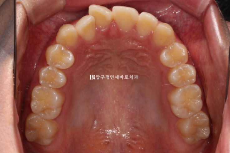 덧니교정 앞니부분교정 치간삭제 후기 관련 이미지 3
