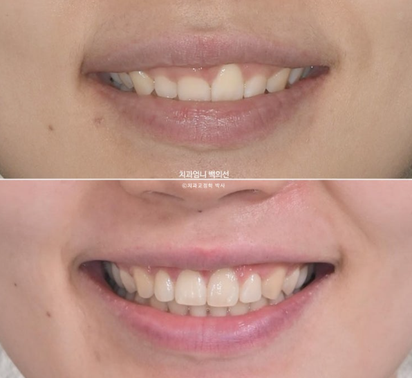 거미스마일 과개교합 교정 잇몸돌출 잇몸 비대칭 관련 이미지 18