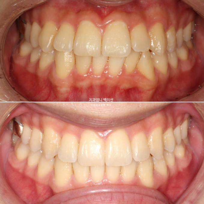 인비절라인 비발치 앞니 돌출 교정 치료기간 2년 5개월 관련 이미지 14