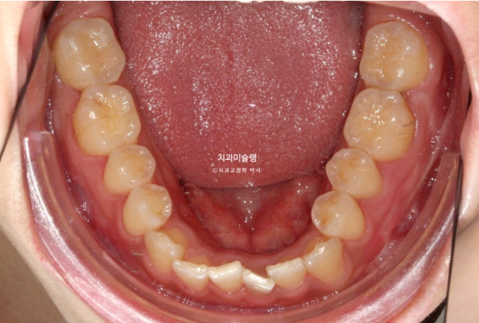 선수술 양악수술 비대칭 주걱턱 잇몸미소 치료 인비절라인 라이트 관련 이미지 6