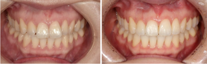 Can Rabbit Teeth Be Corrected? 5-Month Real Case of Butterfly Teeth Anterior Partial Orthodontic Treatment image 8