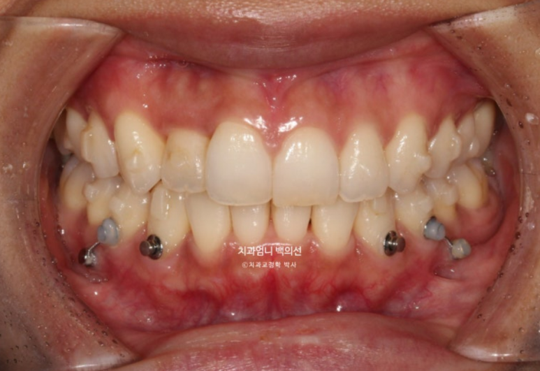 인비절라인 비발치 덧니 교정 반대교합 치료 후기 관련 이미지 6