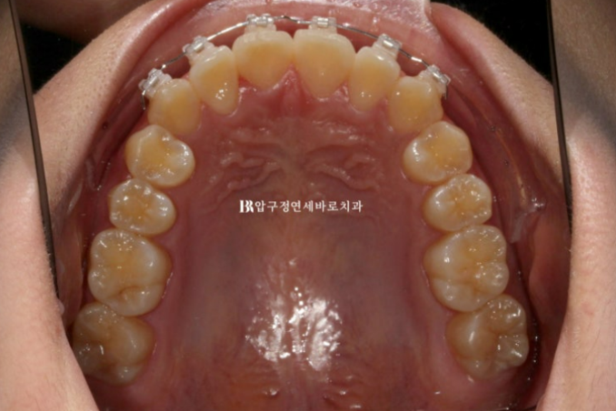 덧니도 부분교정이 가능할까요? 6개월 앞니 부분교정 실제 치료 사례 관련 이미지 5