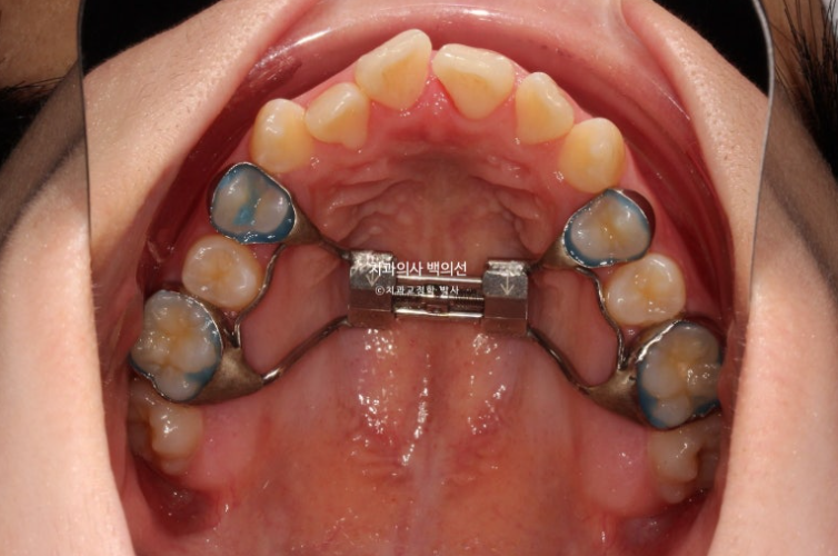 중학생 주걱턱 반대교합 개방교합 덧니 교정 인비절라인 후기 관련 이미지 3