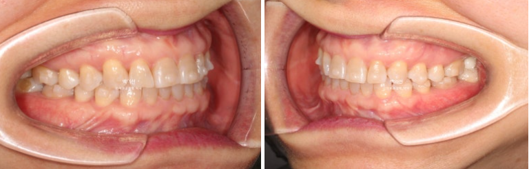 50대 치아교정 :: 인비절라인 익스프레스 치아 벌어짐 단기교정 후기 관련 이미지 10