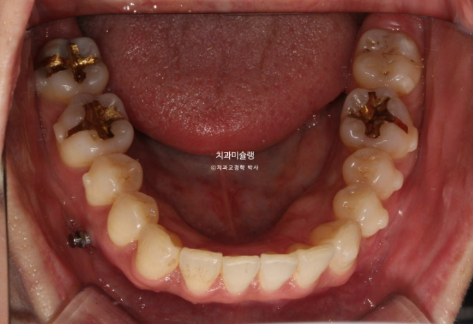 비발치 돌출입 인비절라인 교정 가위교합 중심선 맞추기 관련 이미지 11
