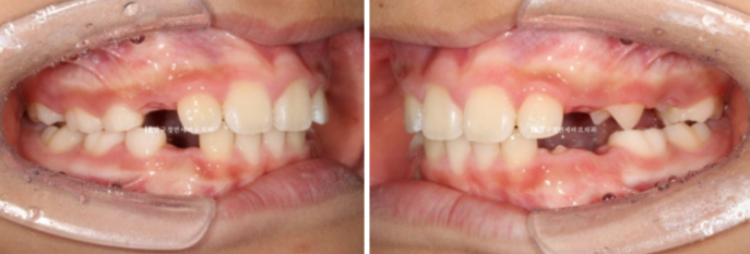 무턱교정 어린이 투명교정 인비절라인 퍼스트 교정 후기 관련 이미지 17