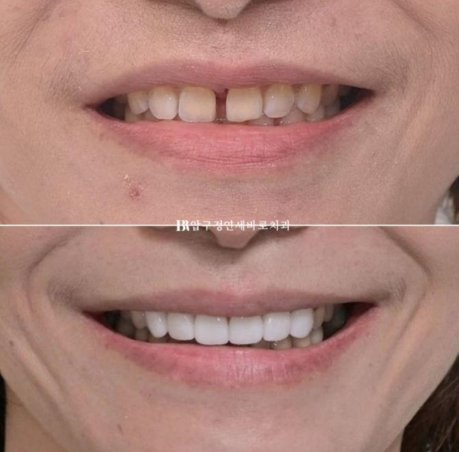 벌어진 치아 교정 인비절라인 라이트 무삭제 라미네이트 치료 관련 이미지 1