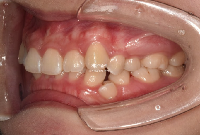 잇몸미소 거미스마일 치료 옥니 교정 잇몸성형 후기 관련 이미지 4