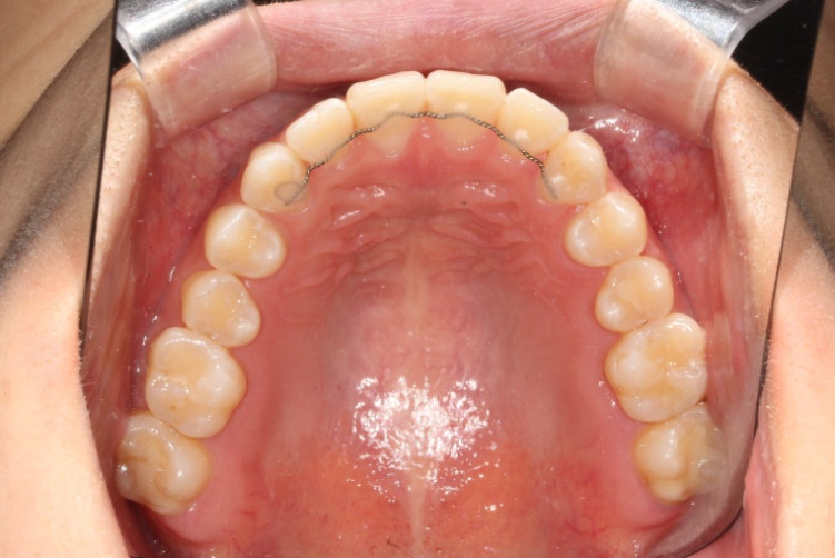 앞니 단기 부분교정 재교정 개방교합 교정 후기 관련 이미지 10