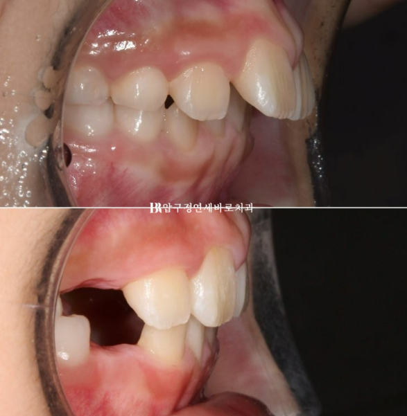Invisalign First Correction for a Retruded Chin in a Child Orthodontic Treatment for Protrusion image 23