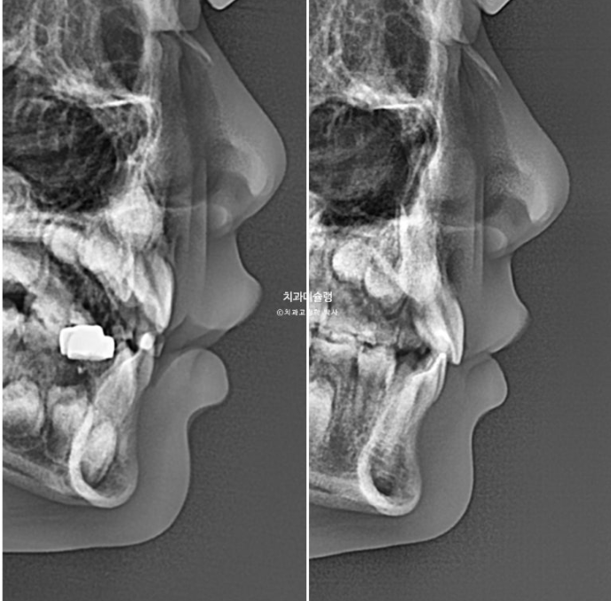 어린이 투명교정 인비절라인 퍼스트 과개교합 교정 후기 관련 이미지 25