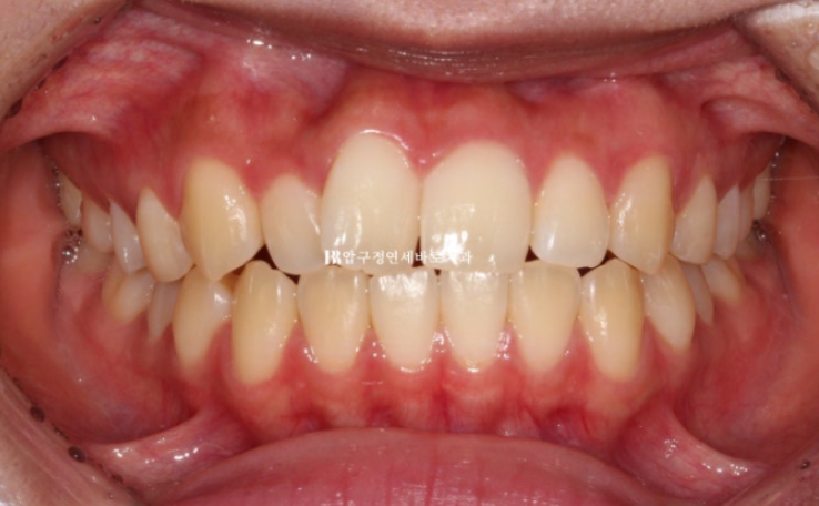 덧니교정 앞니부분교정 치간삭제 후기 관련 이미지 2