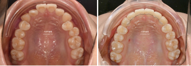 인비절라인 비발치 토끼이빨 교정 덧니 교정 치료기간 1년 8개월 관련 이미지 12