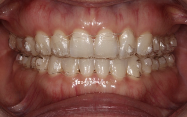 인비절라인 라이트 가위교합 치아 벌어짐 치료 관련 이미지 4