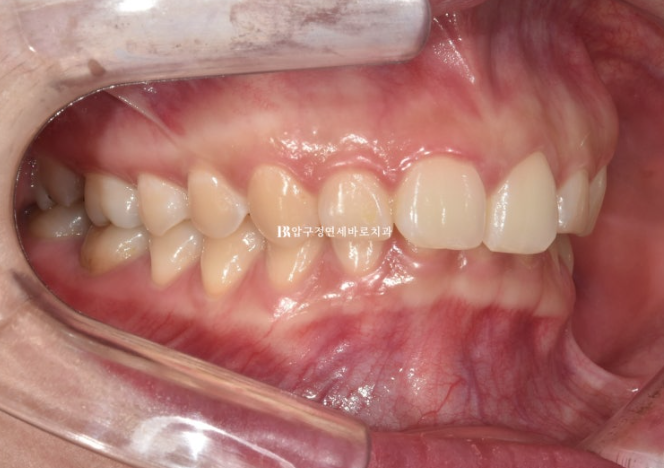 Does Invisalign Prevent Root Movement? Before-and-After Comparison of Extraction Treatment for Protruding Lips image 2
