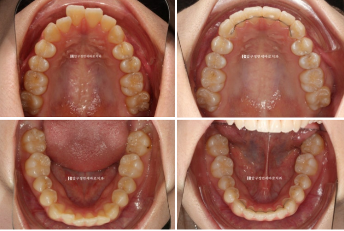 Orthodontic Treatment for International Students: Is Short-Term Treatment Possible in Korea? | A Real 5-Month Front Teeth Partial Orthodontic Case image 8