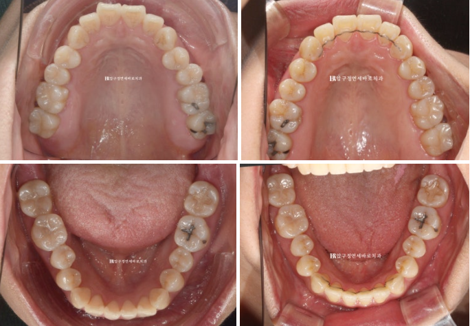 양악수술 선수술 교정 후기 인비절라인 교정 관련 이미지 12