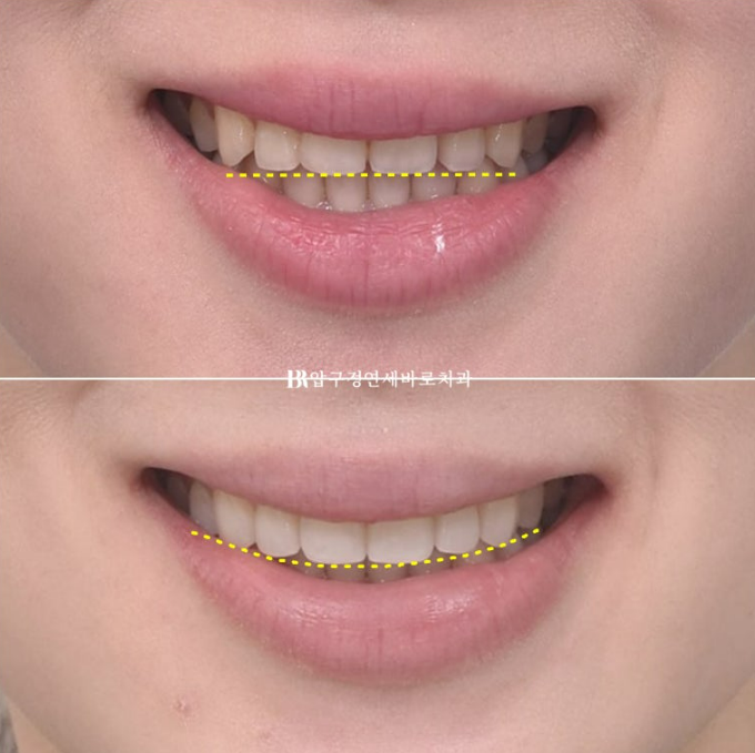 스마일라인 개선 무삭제 라미네이트 실제 두께 ? 관련 이미지 13