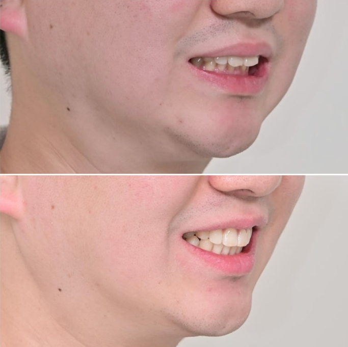 인비절라인 라이트 돌출 과개교합 중심선 교정 치간삭제 치료기간 관련 이미지 18