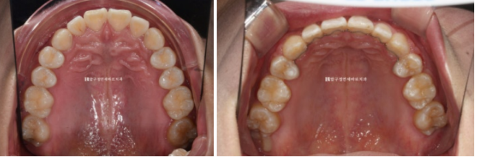 How Do the Buccal Corridors and Smile Line Change After Extraction Treatment for Protruding Teeth?|An Orthodontic Case That Also Improved Lip Incompetence image 11