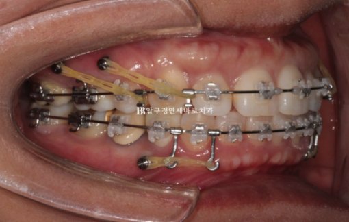 Orthodontic Retreatment in Your 40s | Improvement of Chin Retrusion and Lip Incompetence with Intrusion Orthodontics, Non-Extraction Orthodontic Treatment in Your 40s image 4