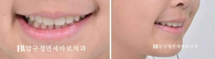 어린이 치아교정 악궁확장 ? 덧니 돌출입 교정 관련 이미지 15