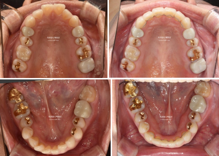50대 캔팅 교합평면 기울어짐 덧니 교정 인비절라인 라이트 교정? 관련 이미지 11