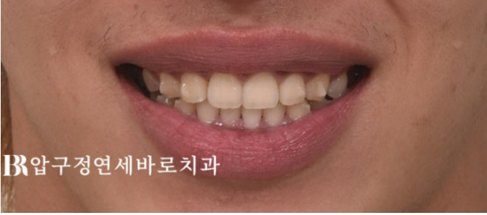 Can Invisalign Lite Correct Deep Bite and the Occlusal Plane? | A Real Case With 14 Aligners Over 4 Months image 6