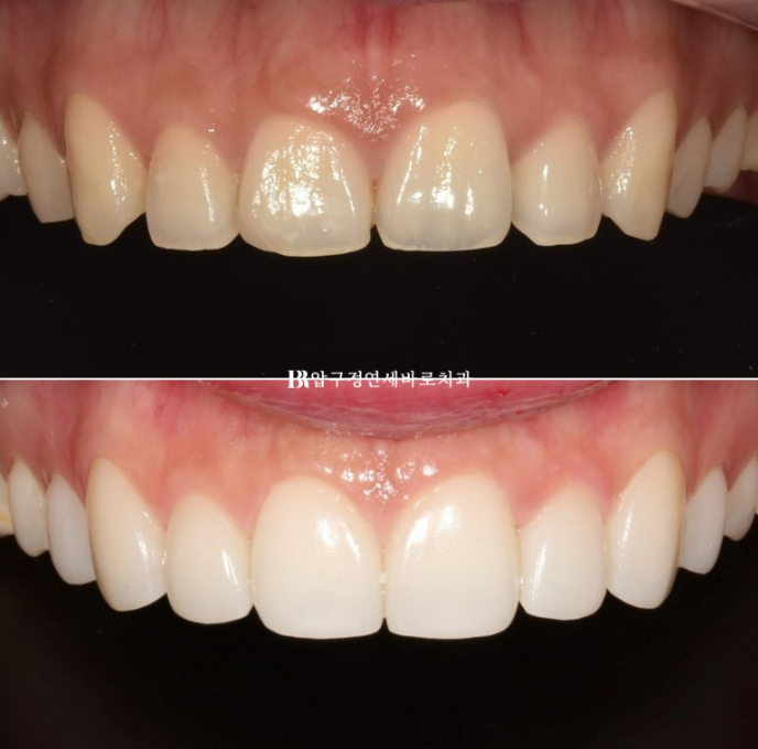 스마일라인 개선 무삭제 라미네이트 실제 두께 ? 관련 이미지 9