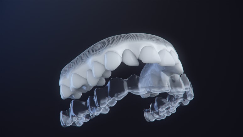 투명한 치아교정장치 인비절라인 종류 알아보기 관련 이미지 4