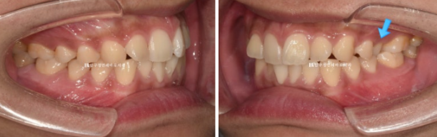 인비절라인 라이트 교정 덧니 이소맹출 반대교합 관련 이미지 3