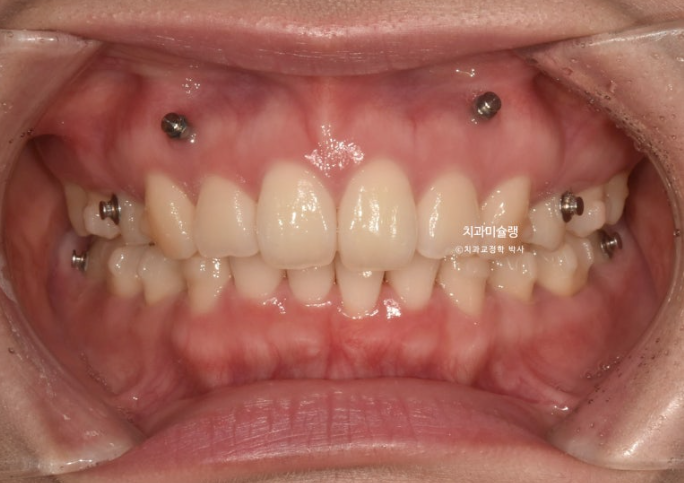 돌출입 덧니 발치 교정 인비절라인 교정 후기 관련 이미지 10
