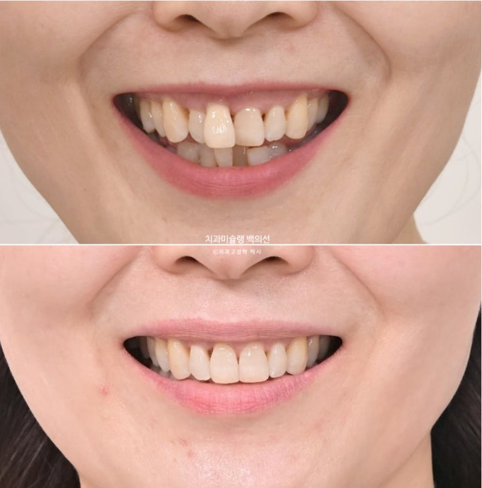 50대 치아교정 중년 발치교정 블랙트라이앵글 치료 후기 관련 이미지 21