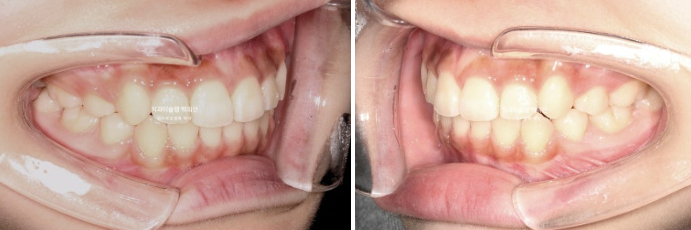 돌출입 무턱 인비절라인 발치교정 덧니 치료기간 1년 11개월 관련 이미지 11