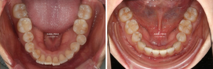30대 돌출입 발치교정 입술부전증 치료 관련 이미지 13