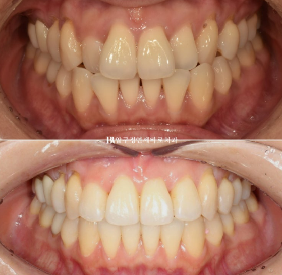 Gangnam Orthodontic Clinic: A Woman in Her 30s’ Rabbit Teeth Correction Review|Six-Month Front Teeth Partial Orthodontic Treatment That Also Improved a Crossbite image 1