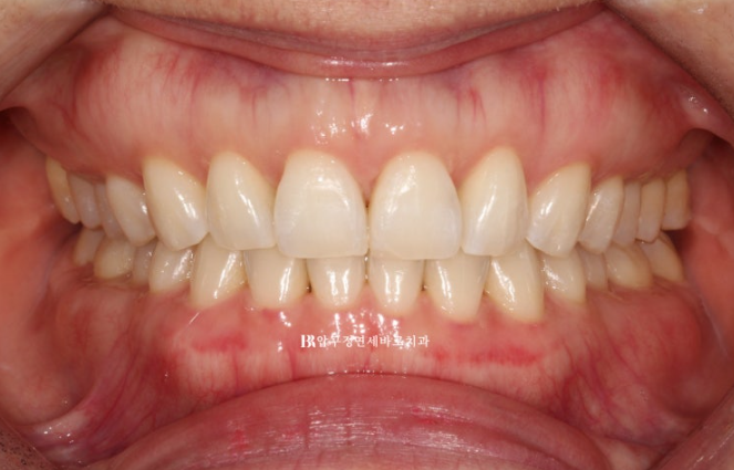 인비절라인 라이트 가위교합 벌어짐 중심선 미니스크류 치료기간 11개월 관련 이미지 8