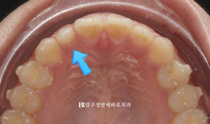 인비절라인 + 무삭제 라미네이트로 왜소치 치료하기 관련 이미지 7