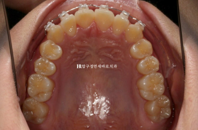 압구정 교정치과 덧니 부분교정 단기교정 후기 관련 이미지 5