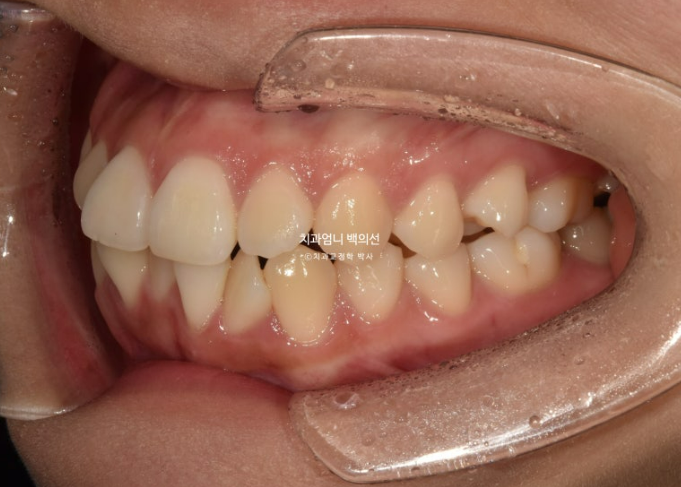 앞니 부분 교정 토끼이빨 덧니교정 ? 관련 이미지 4