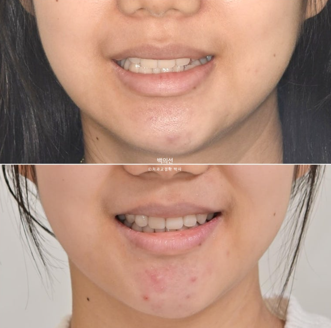 덧니 발치교정 클리피씨 입매 부작용 인중 입술 잇몸 퇴축 관련 이미지 17