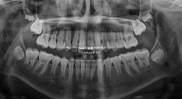어린이 무턱 성장교정 덧니 인비절라인 퍼스트 악궁확장 치료기간 2년 관련 이미지 30