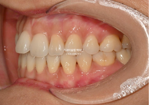 인비절라인 익스프레스 재교정 블랙트라이앵글 치간 삭제 치료기간 6개월 재제작 1회 관련 이미지 3
