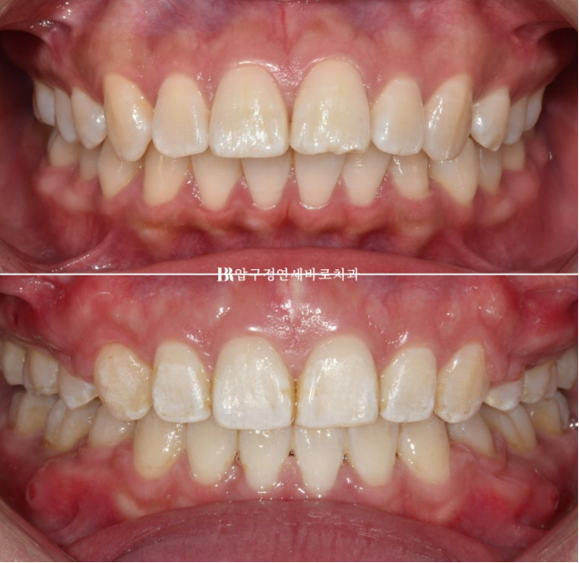 How Do the Buccal Corridors and Smile Line Change After Extraction Treatment for Protruding Teeth?|An Orthodontic Case That Also Improved Lip Incompetence image 12