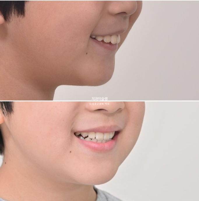 어린이 돌출입 교정 무턱 투명교정 인비절라인 퍼스트 관련 이미지 1